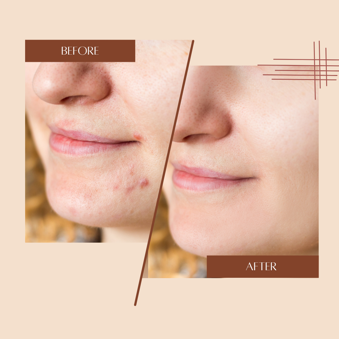 makeU Anti Acne 2-Step Solution