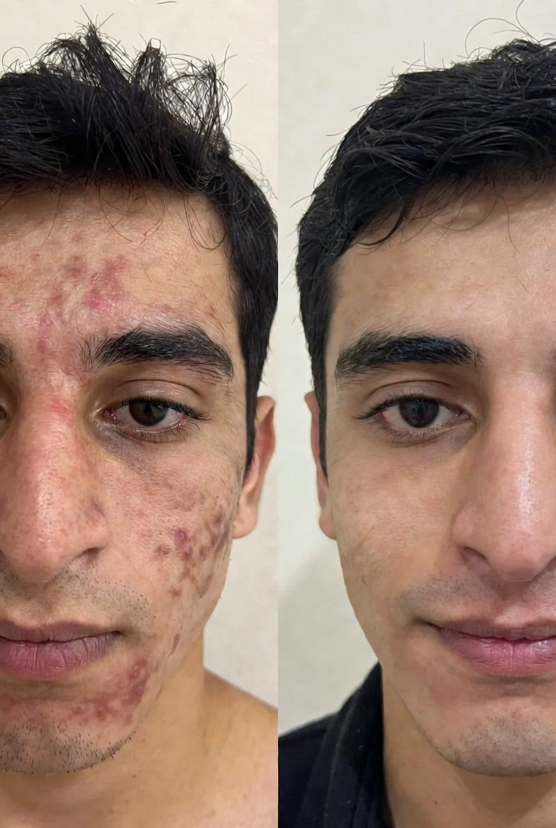 Anti Acne 2-Step Solution