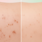Acne Scars & Dark Spots Before After