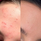 Anti-Acne Solution | Be Acne Free