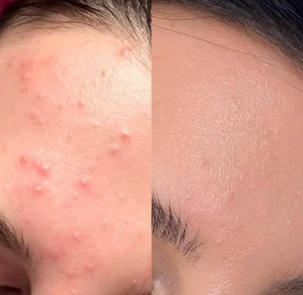 Anti-Acne Solution | Be Acne Free