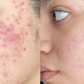 Anti-Acne Solution | Be Acne Free