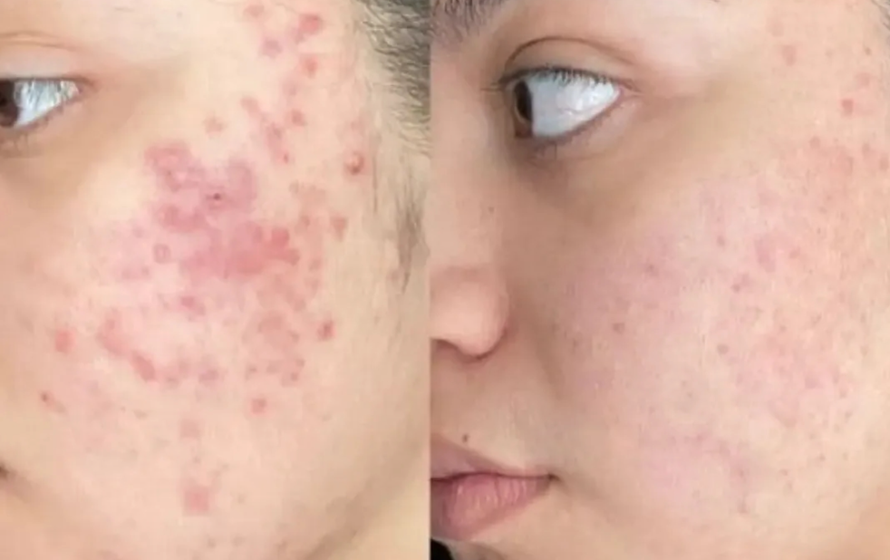 Anti-Acne Solution | Be Acne Free