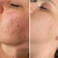 Anti-Acne Solution | Be Acne Free