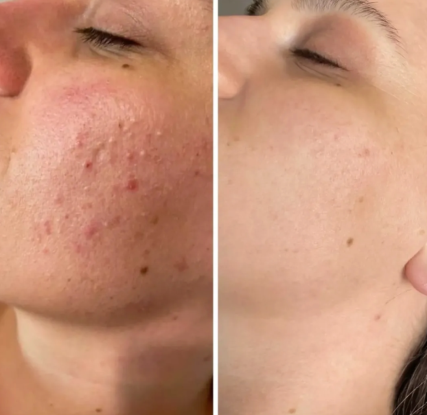 Anti-Acne Solution | Be Acne Free
