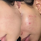 Anti-Acne Solution | Be Acne Free