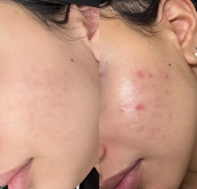 Anti-Acne Solution | Be Acne Free