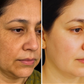 Anti-Acne Solution | Be Acne Free
