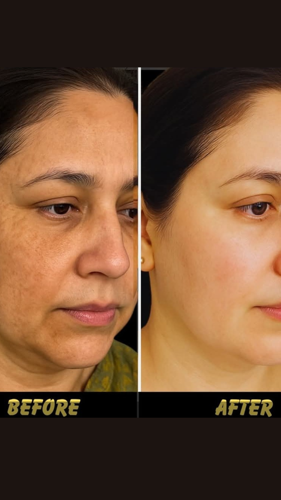 Anti-Acne Solution | Be Acne Free
