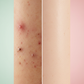 Before & After Anti-Acne Effect