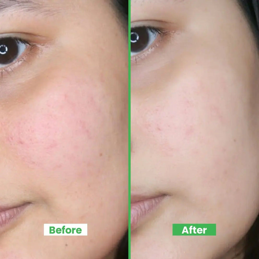ANTI-ACNE GLOW SERUM