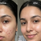 Anti-Acne Solution | Be Acne Free
