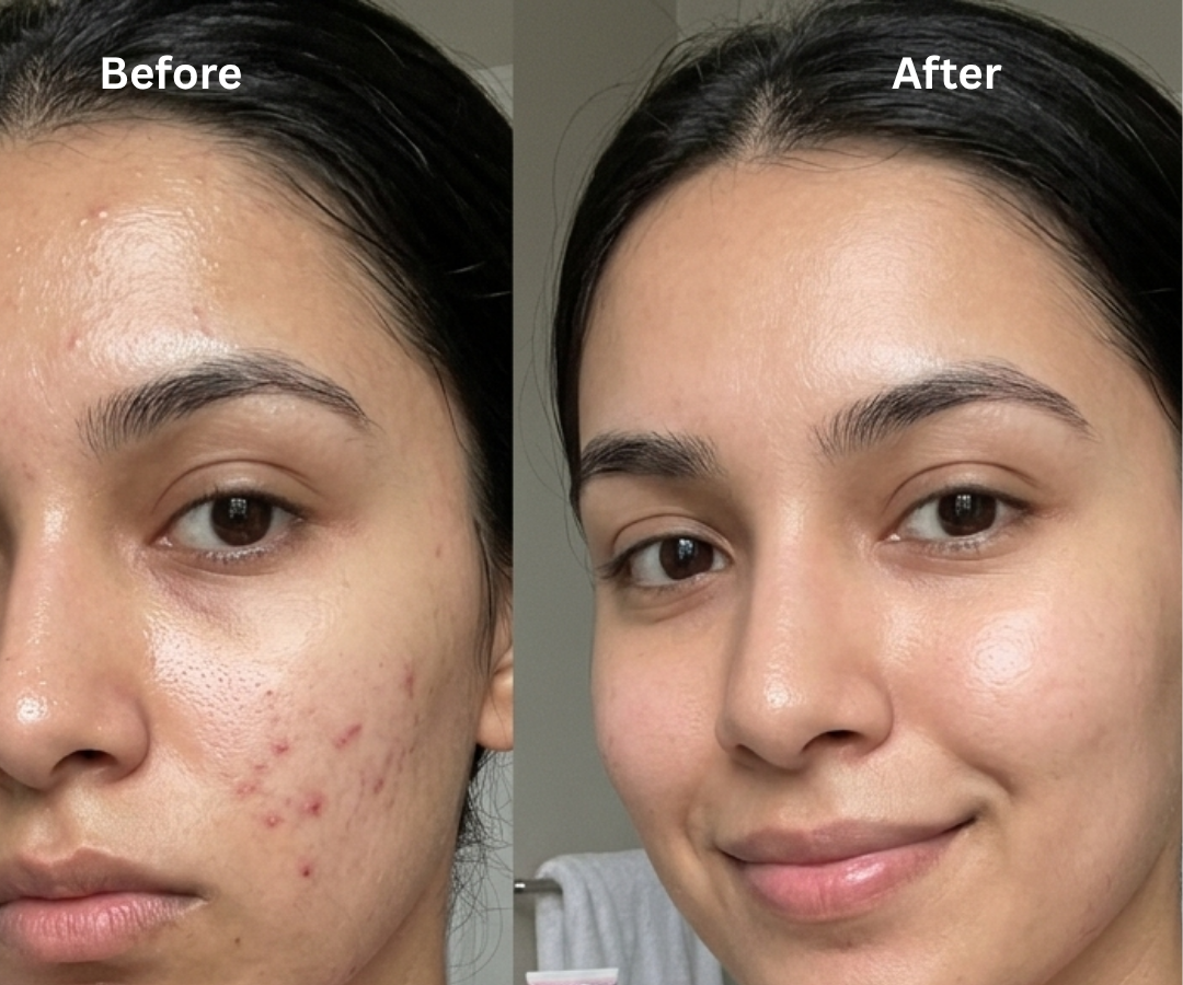Anti-Acne Solution | Be Acne Free
