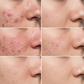 Anti-Acne Facewash Salicylic+ Rice Power Duo