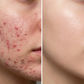 Anti-Acne & Glow Serum | Tea Tree, Aloe Vera, Niacinamide