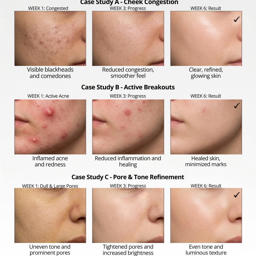 Anti-Acne & Glow Serum | Tea Tree, Aloe Vera, Niacinamide