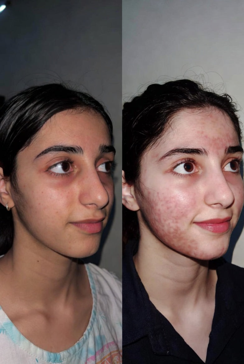 Anti Acne 2-Step Solution