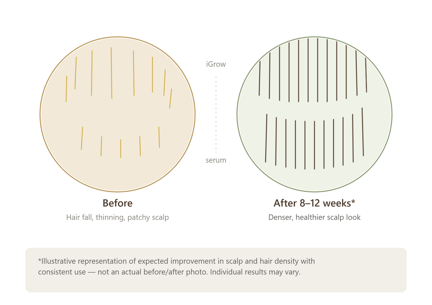 A before-and-after scalp comparison graphic for iGrow serum, showing a thinning scalp with sparse hair lines on the left and a denser, healthier scalp on the right, with explanatory text below.