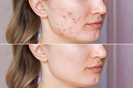 makeU Anti Acne 2-Step Solution