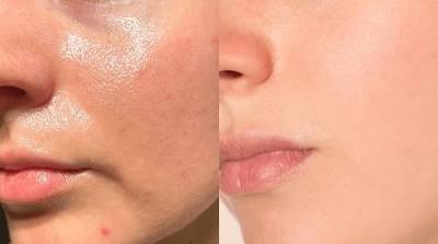makeU Anti Acne 2-Step Solution