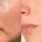 Anti-Acne 2-Step Solution | Face Wash + Serum