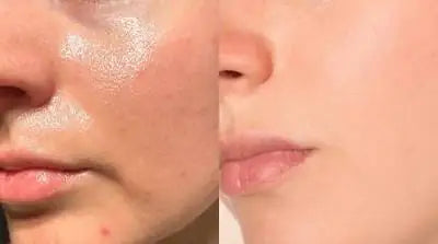 Anti-Acne 2-Step Solution | Face Wash + Serum