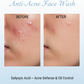 Salicylic Acid Before After