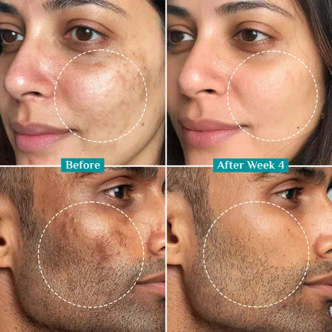 ANTI-ACNE GLOW SERUM